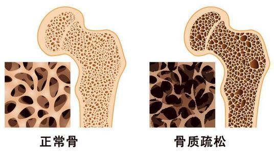研究發(fā)現(xiàn)患有骨質(zhì)疏松癥和骨密度低的女性患聽力損失的風(fēng)險增加