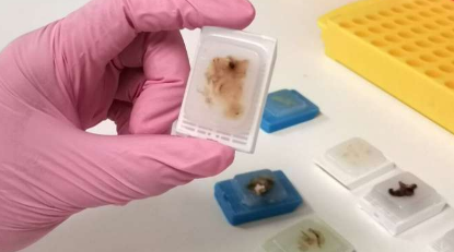 腫瘤基因檢測可以幫助預測卵巢癌的預后
