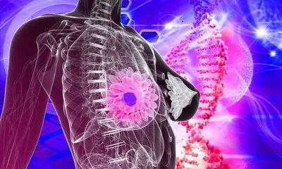 乳腺癌患者化療期間使用抗氧化劑有風險