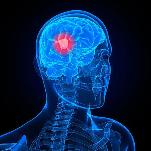 研究人員發(fā)現(xiàn)癌癥擴散到大腦的關鍵驅動力