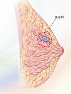 關于乳腺癌轉(zhuǎn)移的PoEM