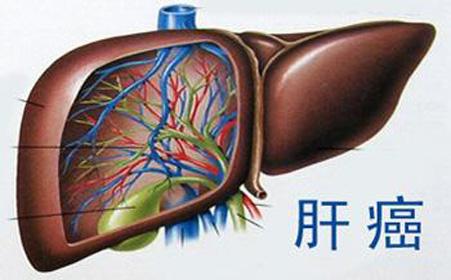基因與最常見(jiàn)的肝癌有關(guān)