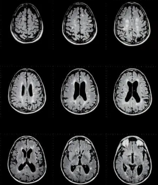 NIH科學家構建了多發(fā)性硬化病變的細胞藍圖