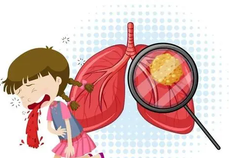 CMV的兒童更有可能在兒童時(shí)期患上結(jié)核病