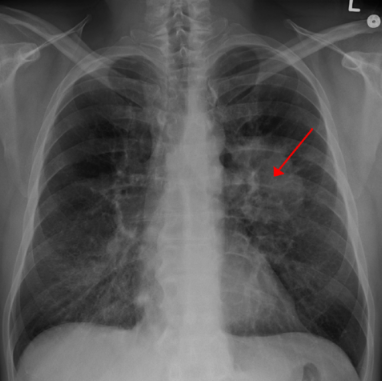 表觀遺傳調(diào)節(jié)劑解釋了為什么一些肺癌患者對常見療法產(chǎn)生抗藥性