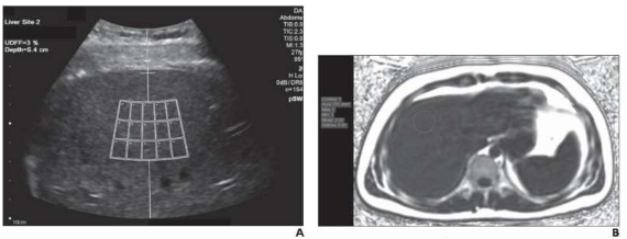 超聲檢測肝臟脂肪與 MRI 質(zhì)子密度脂肪分數(shù)