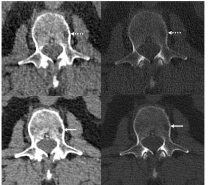 新型光子計(jì)數(shù) CT 改善骨髓瘤骨病檢測(cè)