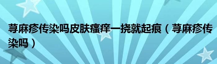 蕁麻疹傳染嗎皮膚瘙癢一撓就起痕（蕁麻疹傳染嗎）