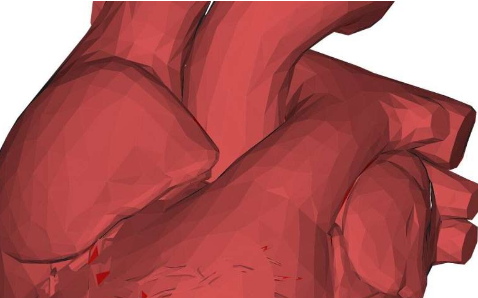 肝纖維化與特定的心力衰竭有關(guān) 無論 HIV 或丙型肝炎狀況如何