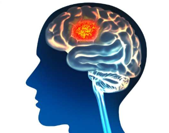 科學(xué)家利用人工智能預(yù)測(cè)腦癌結(jié)果