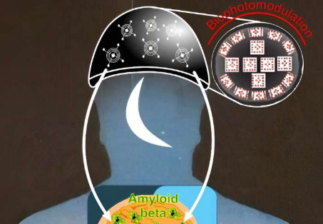 睡眠和清醒期間阿爾茨海默氏病的光療機制