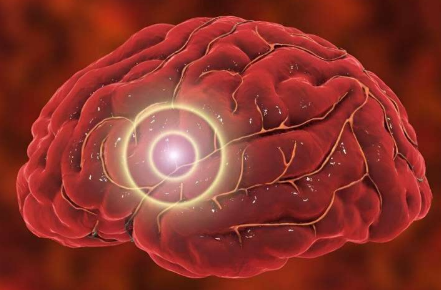 研究發(fā)現(xiàn)中度/重度穿透性 TBI 后患腦癌的風險會增加