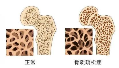男性在骨質疏松癥相關骨折后面臨更大的死亡風險