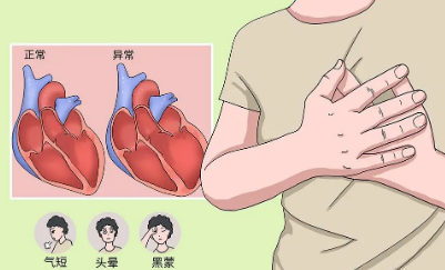 肥厚型心肌病患者的鍛煉