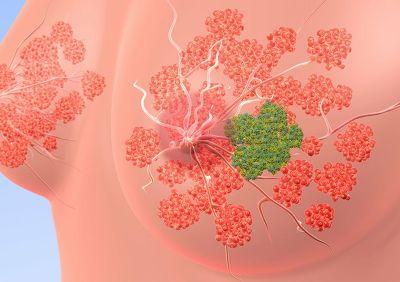 患有乳腺癌的年輕女性在診斷后可能會(huì)面臨財(cái)務(wù)困難